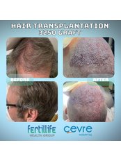Sapphire Hair Transplant - Private Cevre Hospital