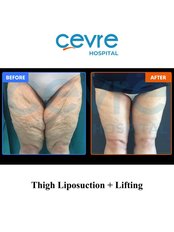 Thigh Lift - Private Cevre Hospital