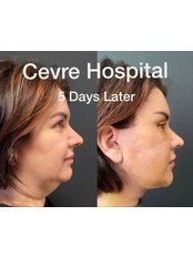 Neck Liposuction - Private Cevre Hospital