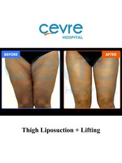Thigh Lift - Private Cevre Hospital