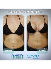 Breast Implants - Private Cevre Hospital