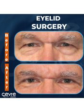 Eyelid Surgery - Private Cevre Hospital