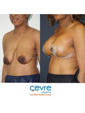 Breast Reduction - Private Cevre Hospital