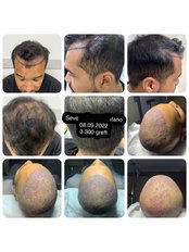 DHI - Direct Hair Implantation - Private Cevre Hospital