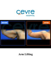 Arm Liposuction - Private Cevre Hospital