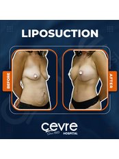 Liposuction - Private Cevre Hospital