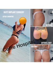 Butt Implants - Private Cevre Hospital