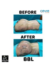 BBL - Brazilian Butt Lift - Private Cevre Hospital