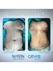 Mommy Makeover - Private Cevre Hospital