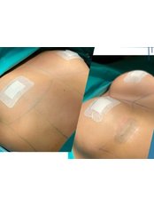 Breast Implants - PST clinic