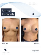 Breast Implants - Surgero