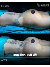 BBL - Brazilian Butt Lift - Surgero