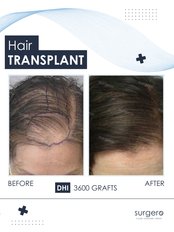 Female Hair Transplant - Surgero