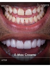 E-Max Crown / Veneer - Surgero