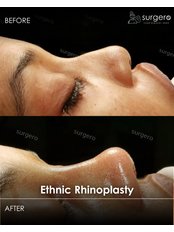 Ethnic Rhinoplasty - Surgero