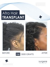 Afro Hair Transplant - Surgero