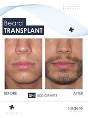 Facial Hair Transplant (Mustache, Beard) - Surgero