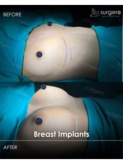 Breast Implants - Surgero
