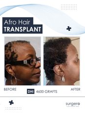Treatment for Female Pattern Hair Loss - Surgero