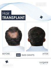 DHI - Direct Hair Implantation Choi Pen - Surgero