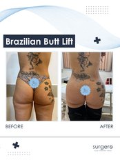 BBL - Brazilian Butt Lift - Surgero