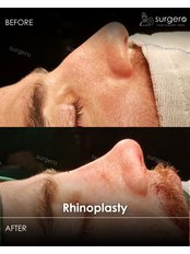 Rhinoplasty - Surgero
