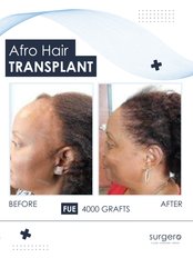 Treatment for Female Pattern Hair Loss - Surgero