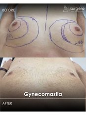 Gynecomastia - Surgero