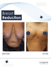 Breast Lift / Reduction - Surgero