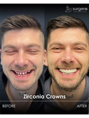 Zirconia Crown / Veneer - Surgero