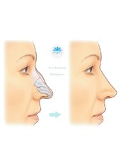 Nasenkorrektur / Rhinoplastik - Surgery İstanbul