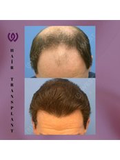 Hair Transplant - West Aesthetics - Turkey