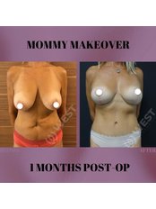Mommy Makeover - West Aesthetics - Turkey