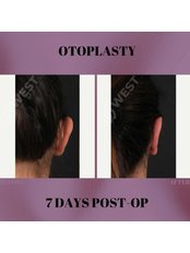 Otoplasty - West Aesthetics - Turkey