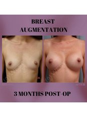 Breast Implants - West Aesthetics - Turkey