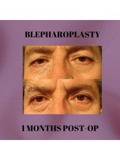 Blepharoplasty - West Aesthetics - Turkey