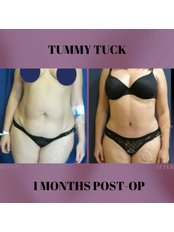 Tummy Tuck - West Aesthetics - Turkey