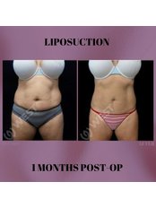 Liposuction - West Aesthetics - Turkey