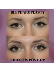Eyelid Surgery - West Aesthetics - Turkey
