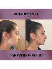 Rhinoplasty - West Aesthetics - Turkey
