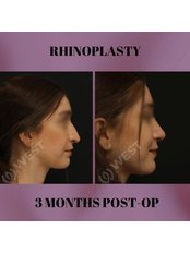 Rhinoplasty - West Aesthetics - Turkey