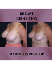Breast Reduction - West Aesthetics - Turkey