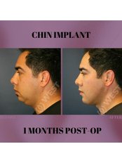 Chin Implant - West Aesthetics - Turkey