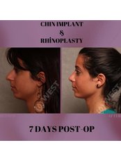 Chin Implant - West Aesthetics - Turkey