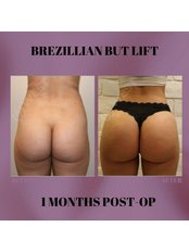 BBL - Brazilian Butt Lift - West Aesthetics - Turkey