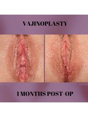 Vaginoplasty - West Aesthetics - Turkey