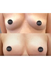 Breast Implants - YOO RETOUCH
