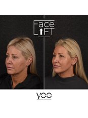 Facelift - YOO RETOUCH