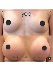 Breast Lift - YOO RETOUCH