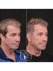 Facelift - YOO RETOUCH